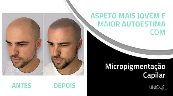 Micropigmentação Capilar Feminina: Solução para Rarefação e Volume