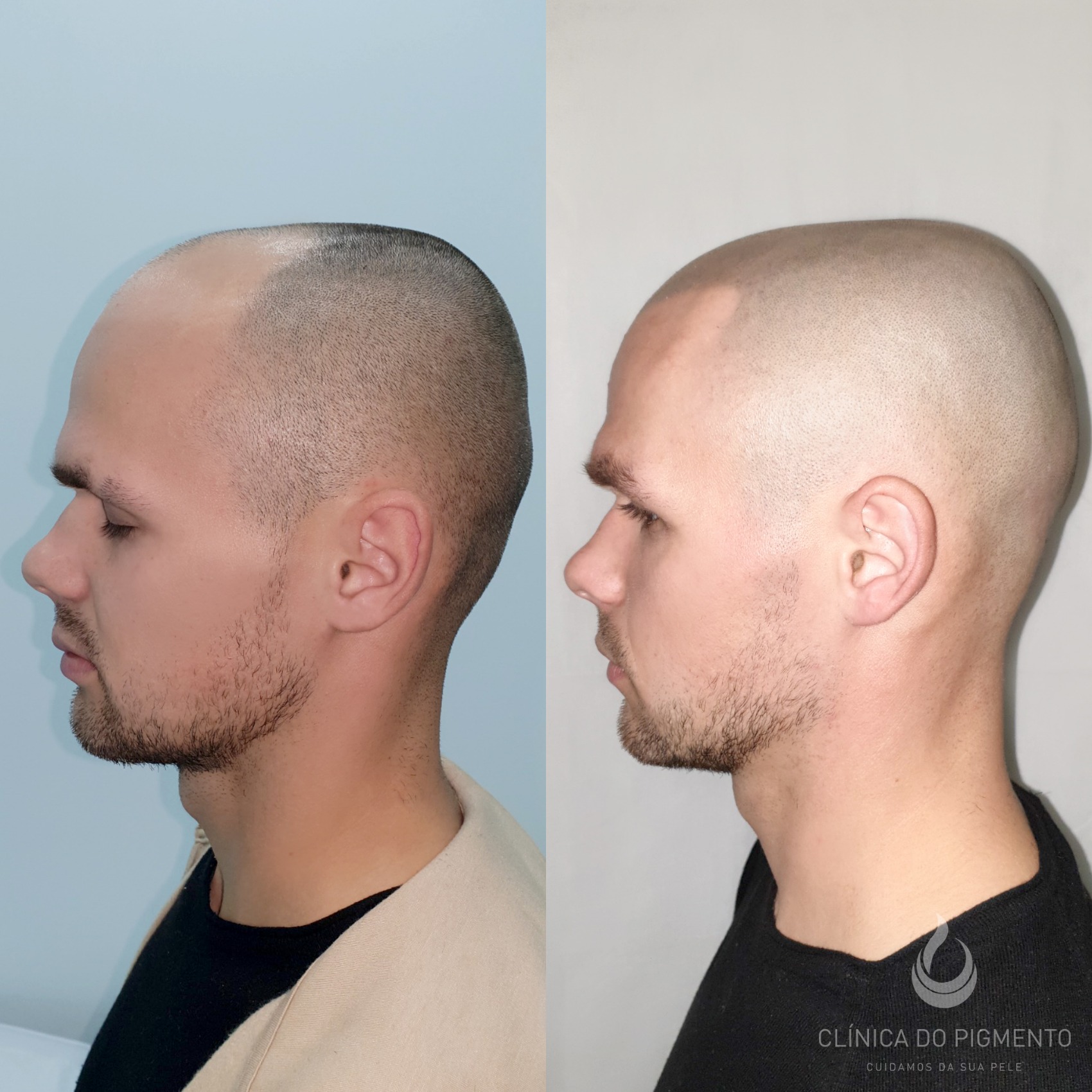 Micropigmentação capilar efeito densidade valor