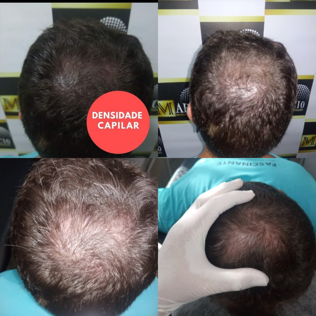 Como Escolher a Melhor Clínica de Micropigmentação Capilar em São Paulo?