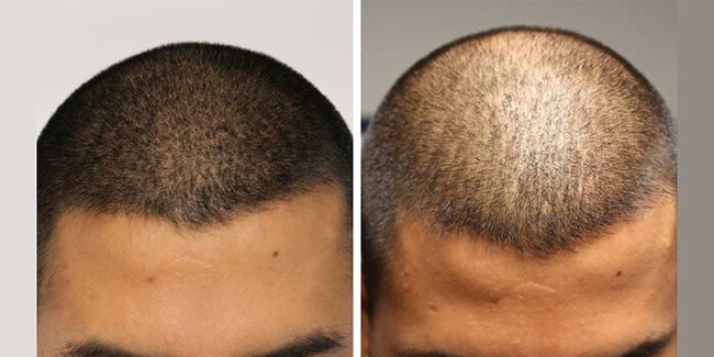 Micropigmentação capilar vs Transplante