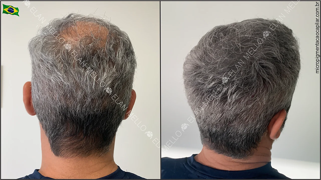 Quanto Custa um Transplante Capilar no Brasil? Guia Completo de Preços