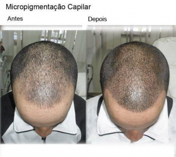 Micropigmentação e Transplante Capilar: É Possível Combinar as Duas Técnicas?