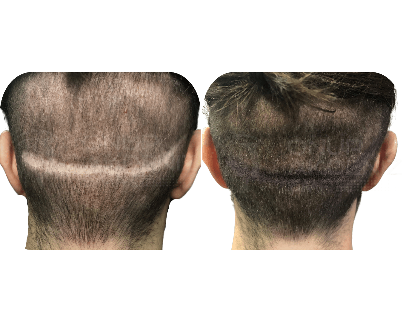 Micropigmentação capilar vs Transplante