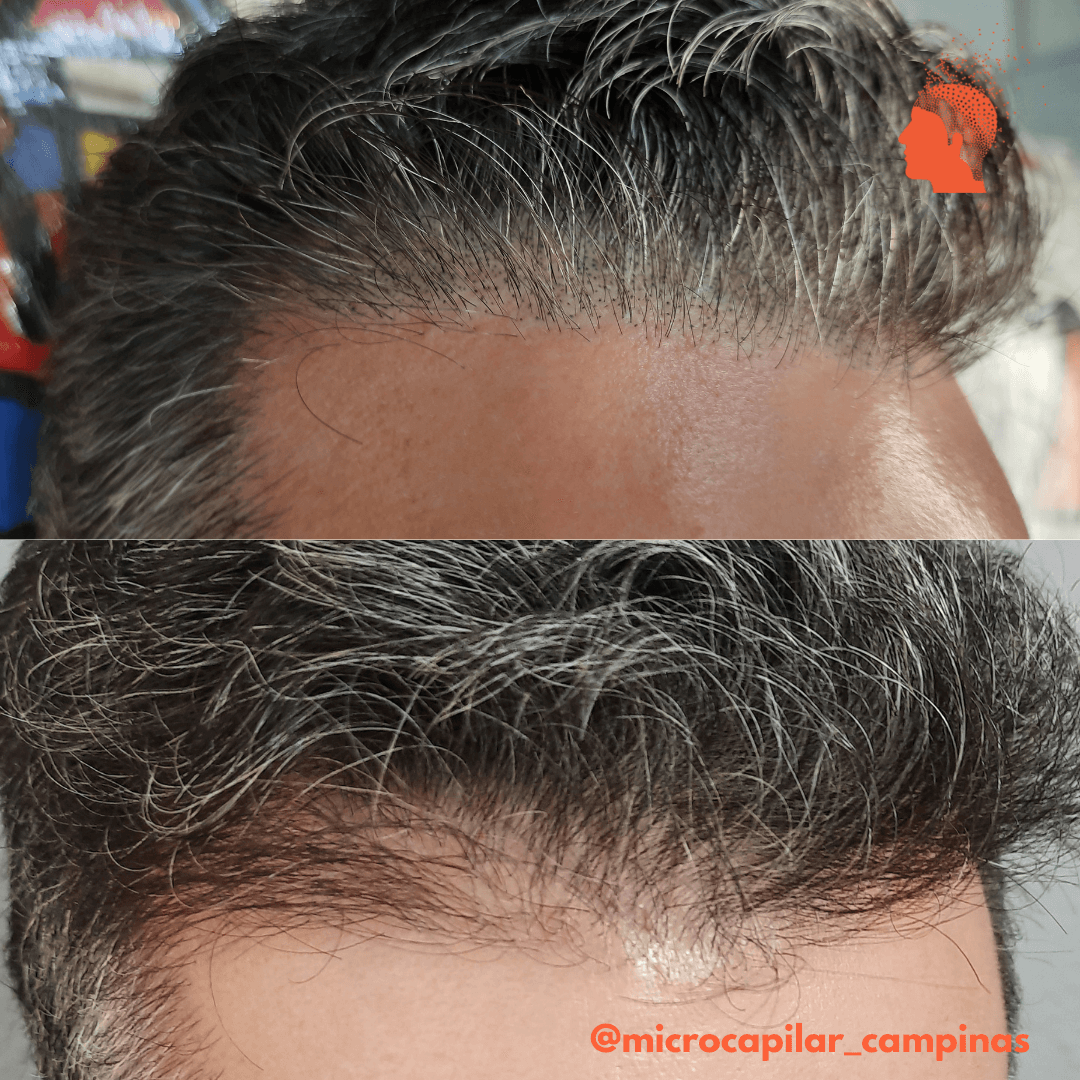 Micropigmentação Capilar: Tudo o que Você Precisa Saber Antes de Fazer