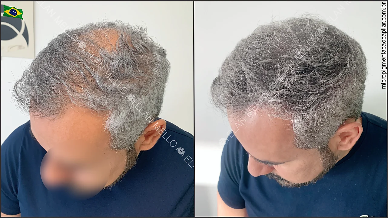 Transplante Capilar FUE: A Técnica Mais Avançada para Recuperar Seus Fios
