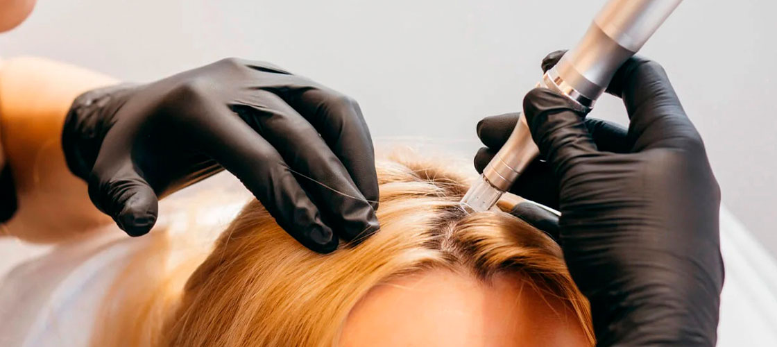 MMP Capilar: Guia Completo sobre o Procedimento e Seus Benefícios
