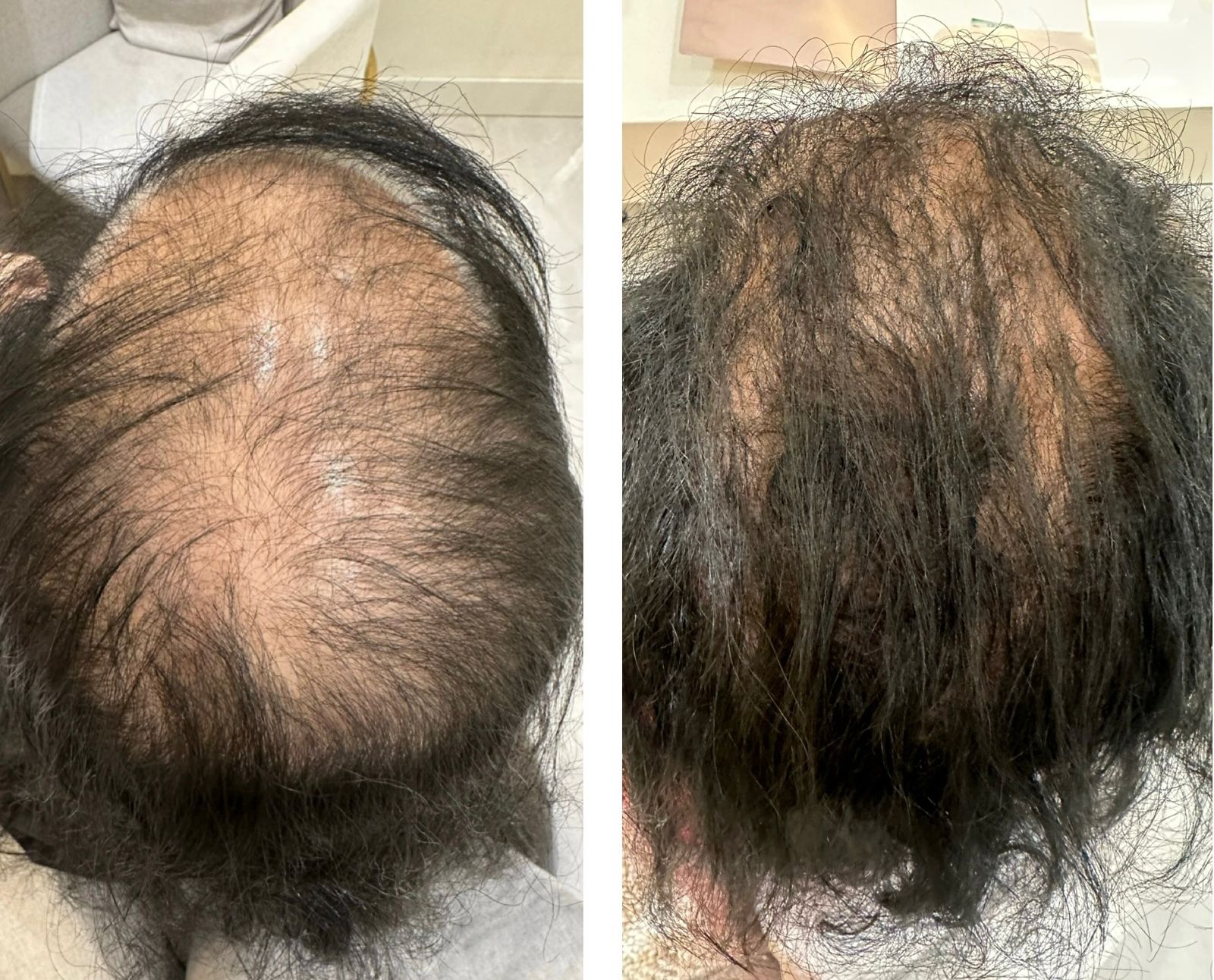 Como Escolher a Melhor Clínica de Tricologia para MMP Capilar em SP