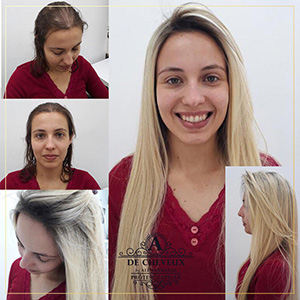 Orçamento transplante capilar feminino Campo Grande