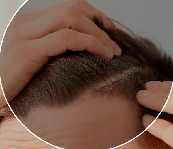 Técnica FUE para Mulheres: O que Você Precisa Saber Antes do Transplante Capilar