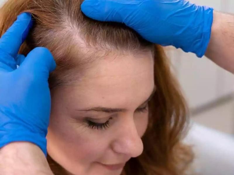 Orçamento transplante capilar feminino Rio Branco