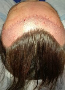 Transplante capilar feminino: Mitos e verdades