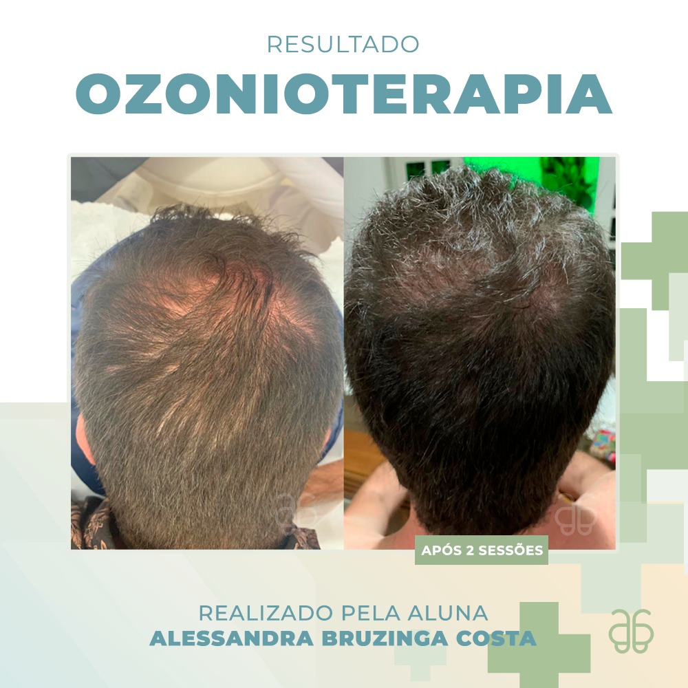 Ozonioterapia Capilar para Queda de Cabelo: Mitos e Verdades