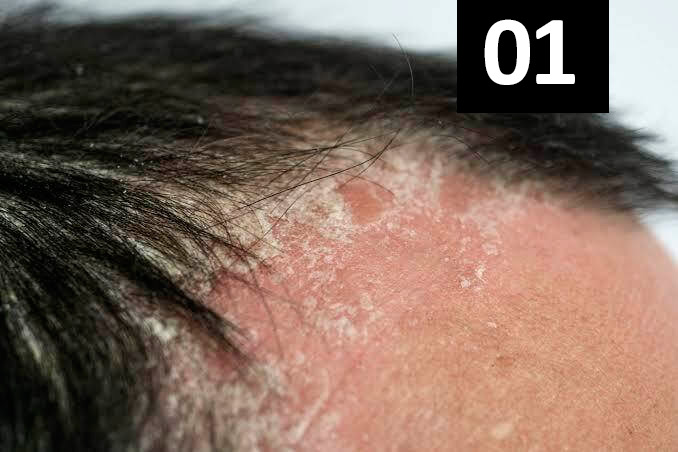 Ozonioterapia capilar para dermatite seborreica