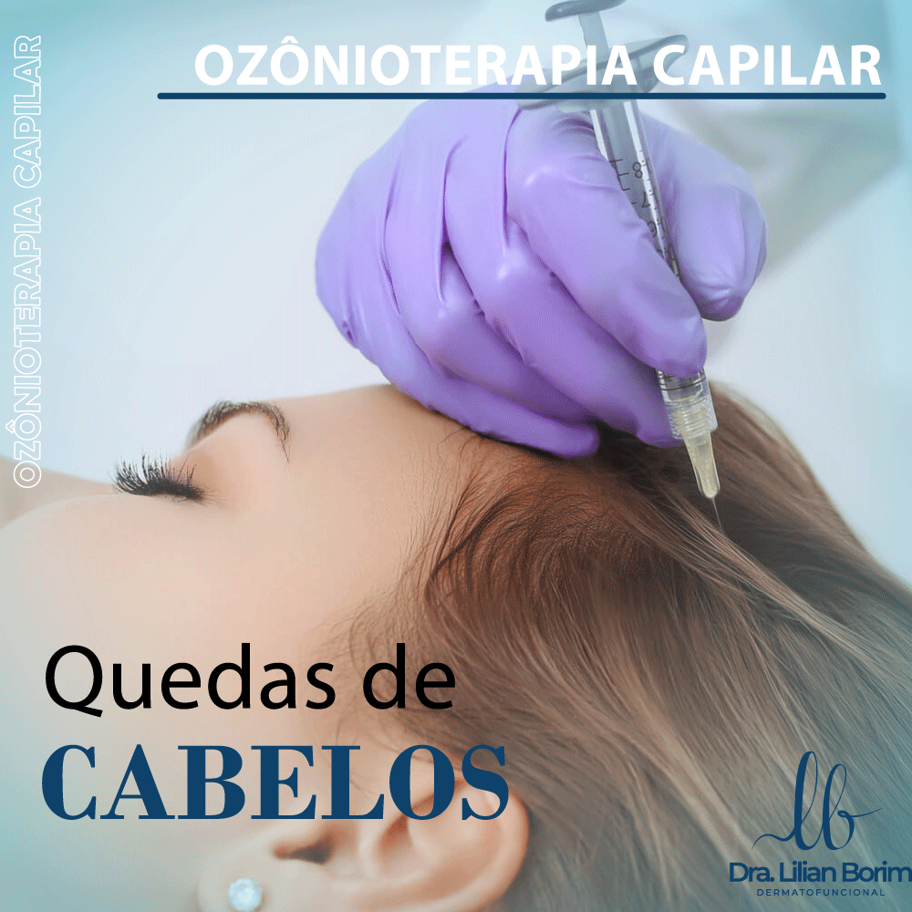 Benefícios da Ozonioterapia Capilar: O Que Esperar do Tratamento