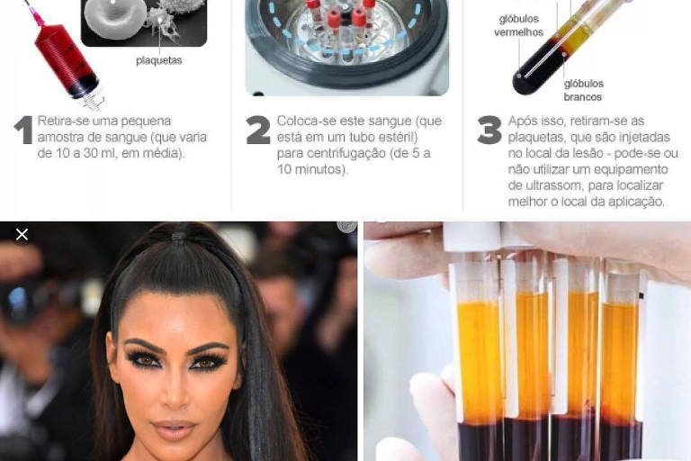 PRP capilar é permitido no Brasil 2026