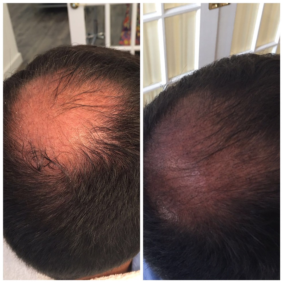 melhores clínicas de PRP capilar no Brasil