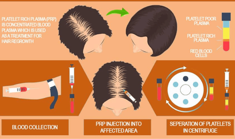 erros comuns ao fazer tratamento PRP capilar