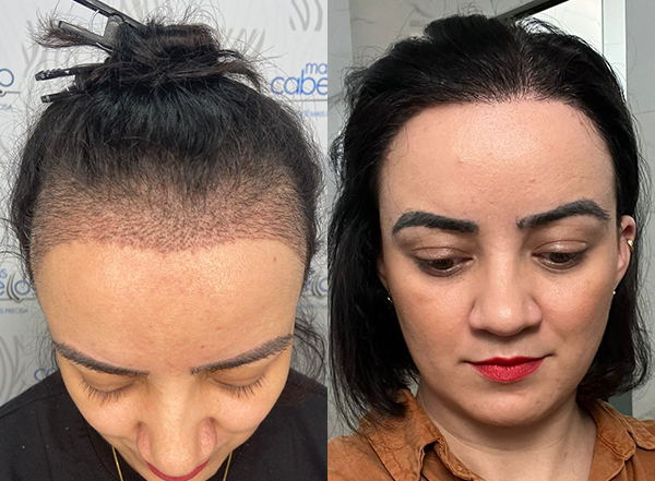 Quanto custa transplante capilar feminino RJ