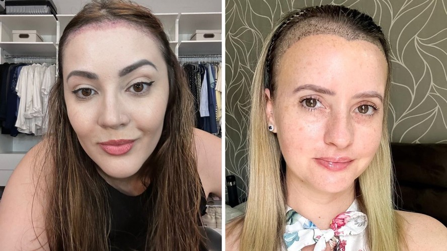 Transplante capilar feminino: Entenda os fatores que influenciam o preço no RJ