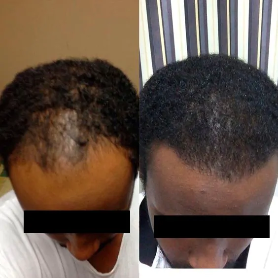 Recuperação e cuidados pós-transplante capilar: Dicas para um resultado duradouro