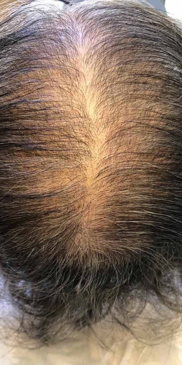 Queda de cabelo pós-parto tratamento preço