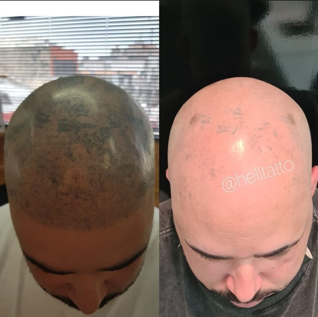 preço remoção micropigmentação capilar a laser