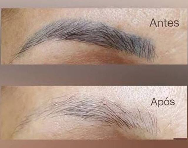 custo remoção micropigmentação capilar