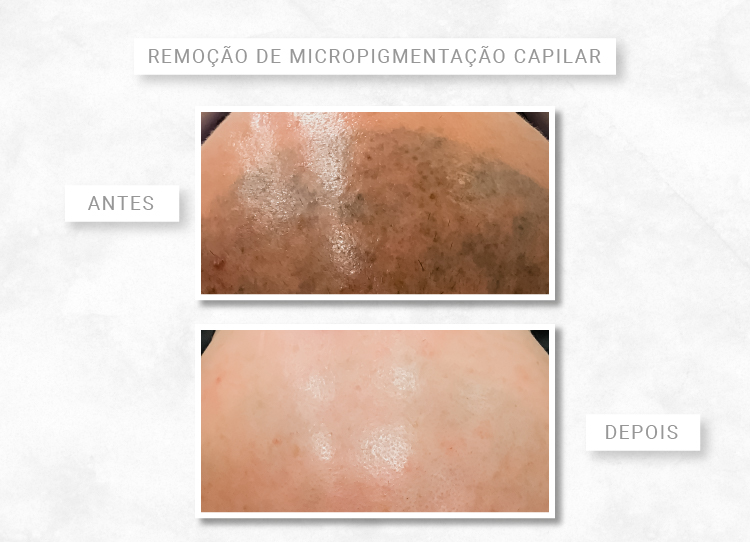 valor sessão remoção micropigmentação capilar