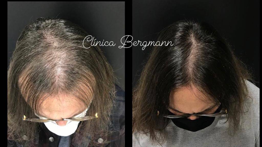 Rigenera capilar antes e depois feminino