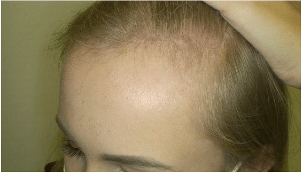 Rigenera Hair: Mitos e Verdades sobre o tratamento regenerativo