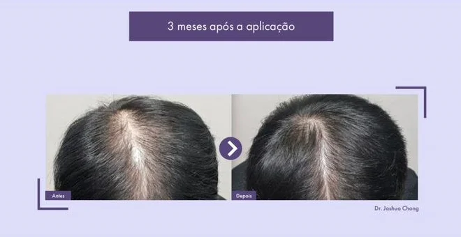 Rigenera Hair: O que esperar nos primeiros meses