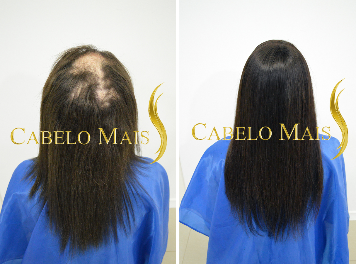 Como funciona o Rigenera Hair: Guia completo do procedimento