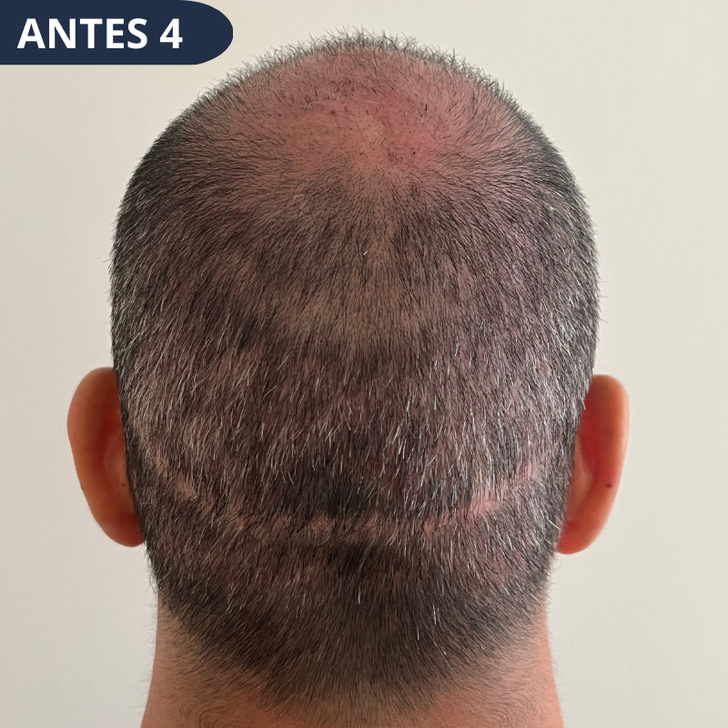 Depoimentos reais: Mulheres que transformaram o cabelo com Rigenera Hair