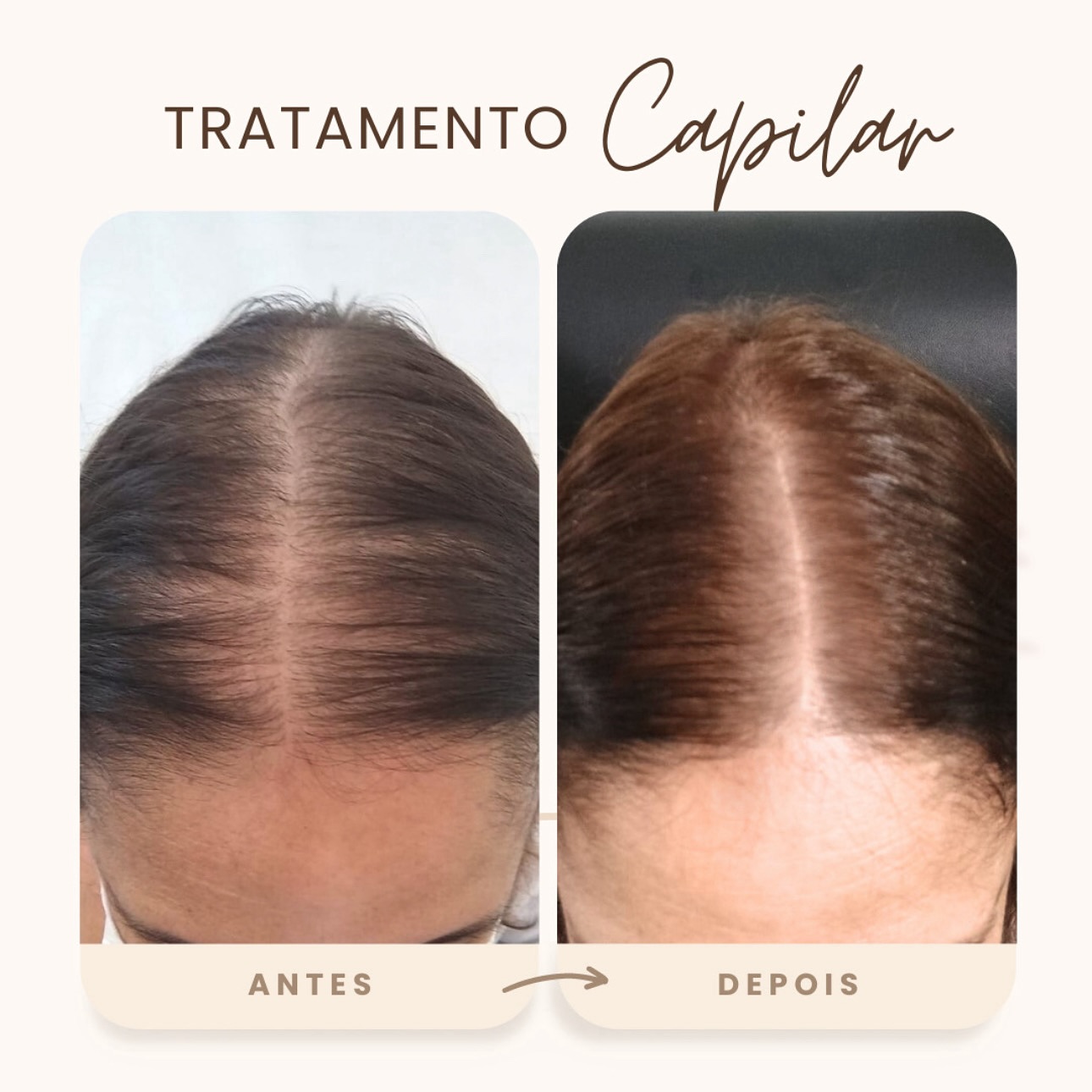 Rigenera Hair vs Implante Capilar: Qual a melhor opção para mulheres?