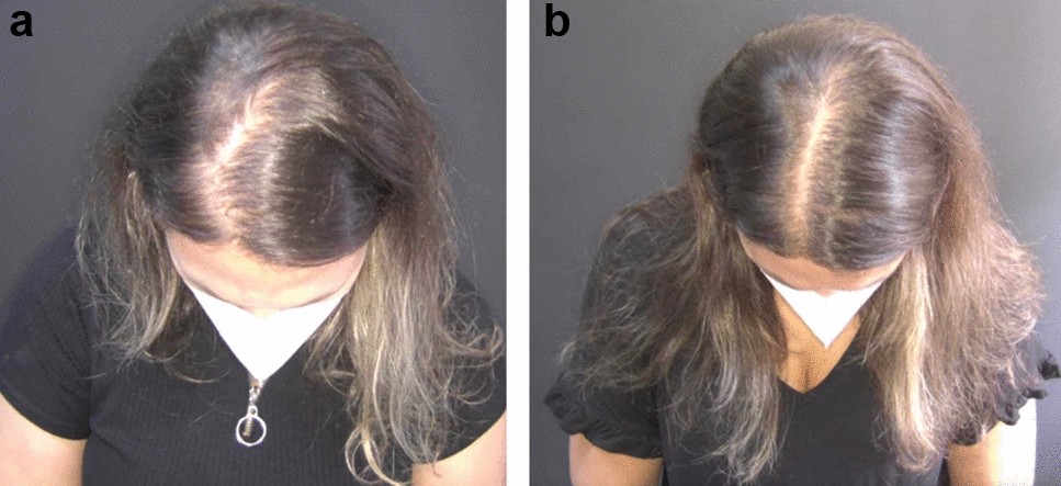 Como funciona o Rigenera Hair: Guia completo do procedimento