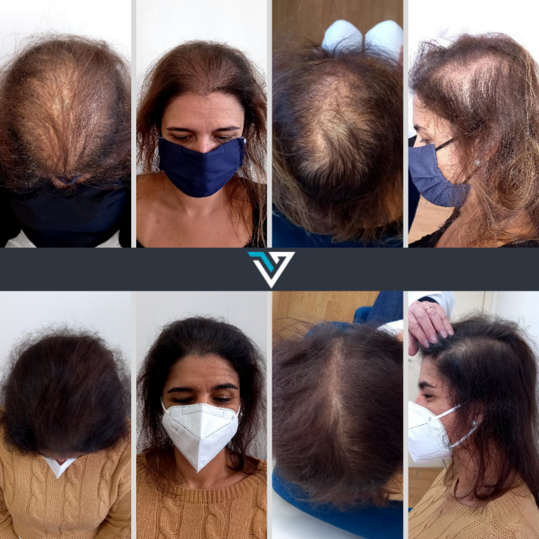 Depoimentos reais: Mulheres que transformaram o cabelo com Rigenera Hair