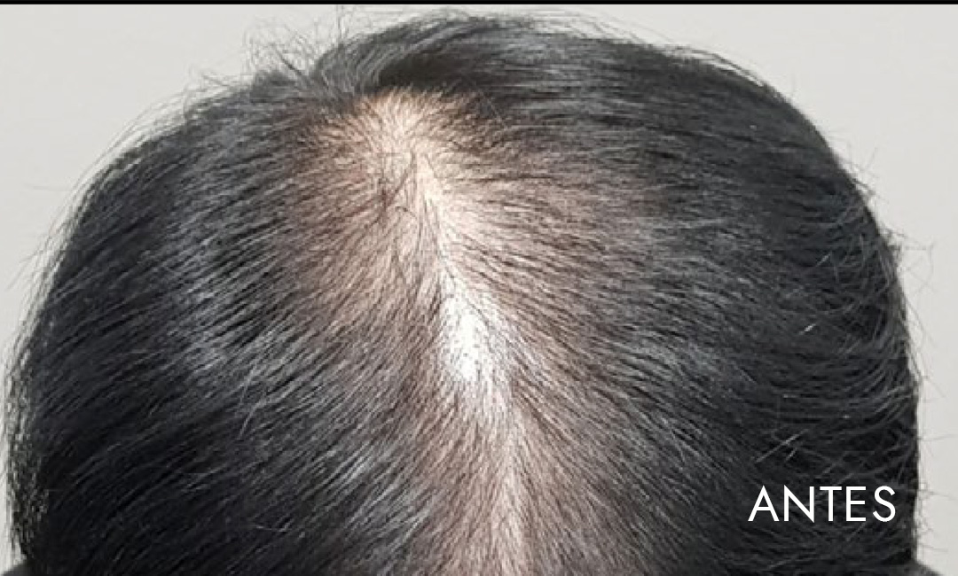 Rigenera Hair: Mitos e Verdades sobre o tratamento regenerativo