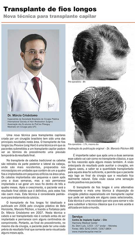 Técnica Preview Long Hair transplante preço