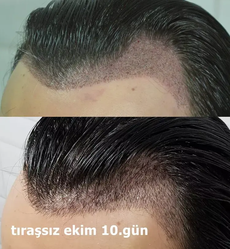 Transplante capilar sem raspar: Entenda os benefícios e o processo