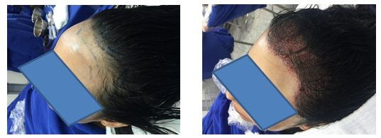 FUE vs. FUT vs. Preview Long Hair: Qual a melhor técnica para você?