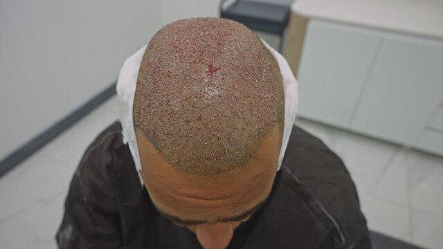 Guia Completo: Como Escolher sua Clínica de Transplante Capilar na Turquia