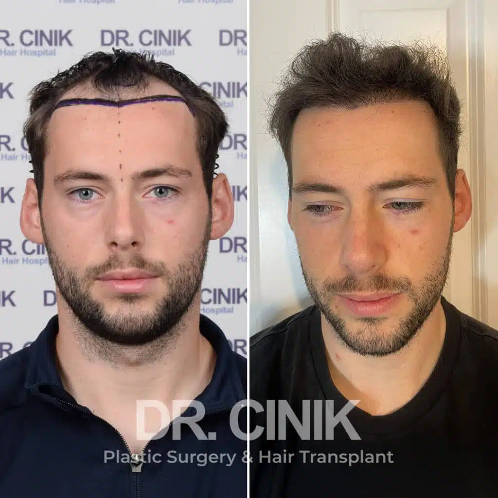 Tradução e Suporte em Português para Seu Transplante Capilar em Istambul