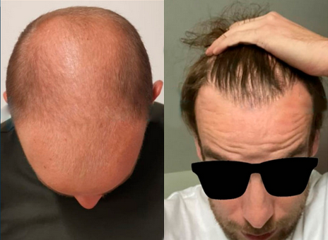 Comparativo de Preços: Transplante Capilar na Turquia vs. Outros Países