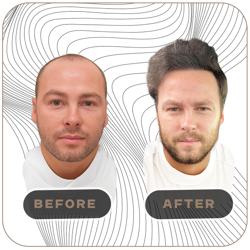 Pós-Operatório do Transplante Capilar: Dicas e Cuidados Essenciais