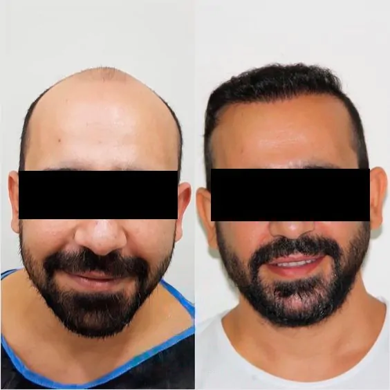 Fatores Essenciais que Influenciam o Custo do seu Transplante Capilar