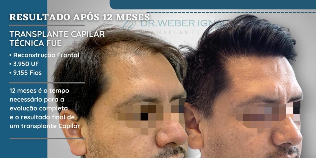 O Que Esperar Após um Transplante Capilar com Fios Longos?