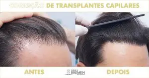 Transplante capilar com fios longos valor