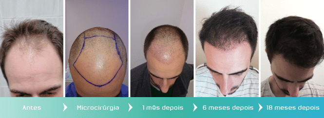 Transplante Capilar Fios Longos: O Que Você Precisa Saber Antes de Fazer