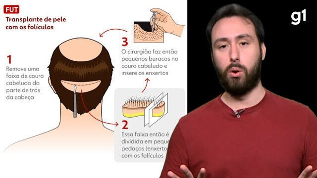 Long Hair FUE vs. FUE Tradicional: Qual a Melhor Opção para Você?