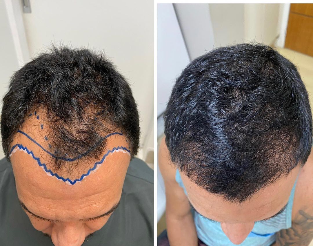 Fatores Essenciais que Influenciam o Custo do seu Transplante Capilar